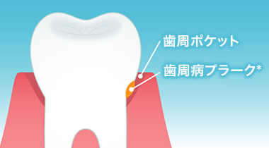 歯周病のイメージ図